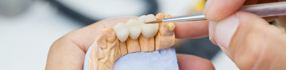 what are the different types of bridges for teeth