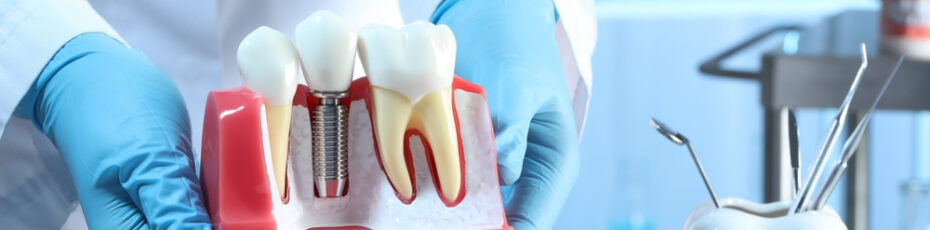 unraveling the mystery can dental implants get cavities