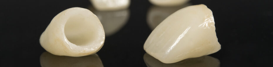 what you need to know about dental crowns