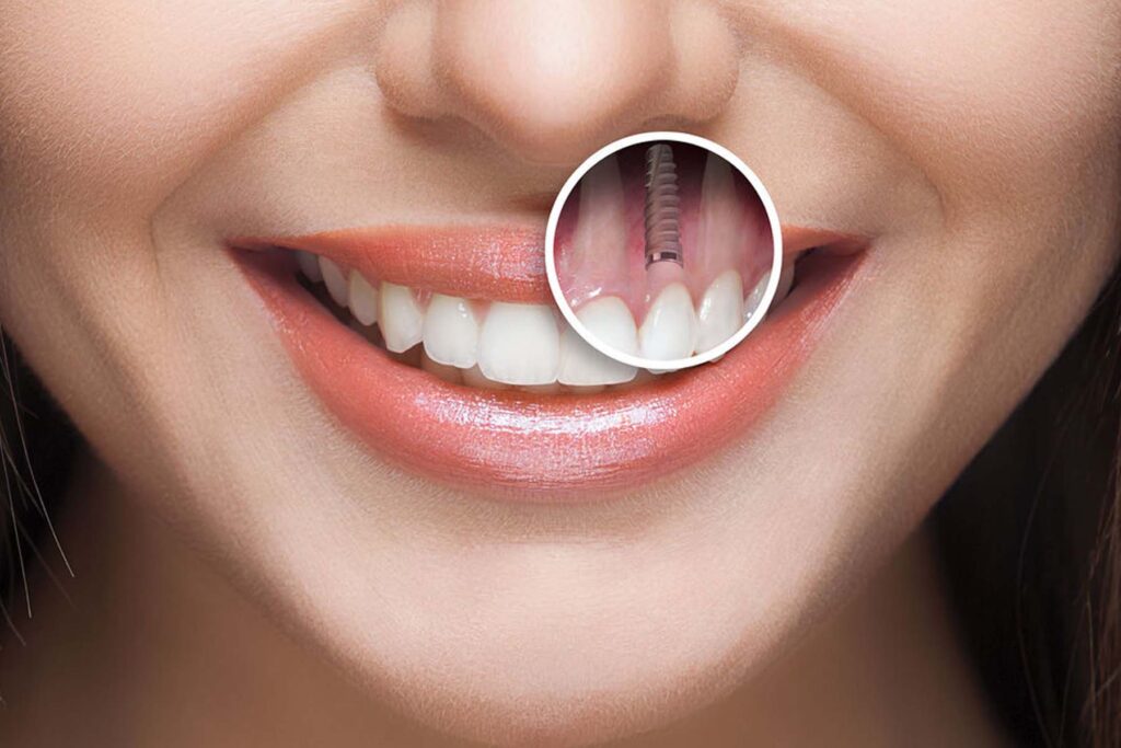 What is the Purpose of a Dental Implant?