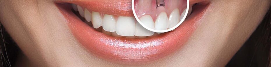 What is the Purpose of a Dental Implant?